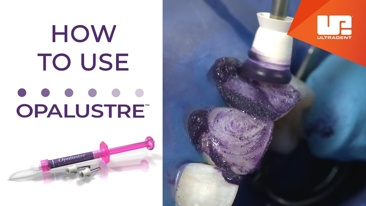How To Use Opalustre™ | Chemical and Mechanical Abrasion Slurry from Opalescence™ Tooth Whitening