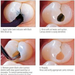 Alternative view of UltraDent Seek & Sable Seek