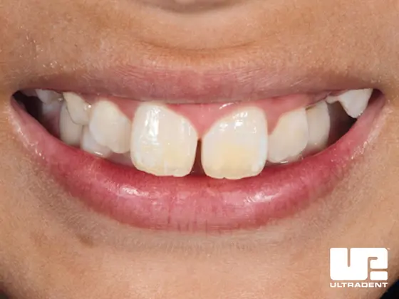 After Opalustre Abrasion Slurry