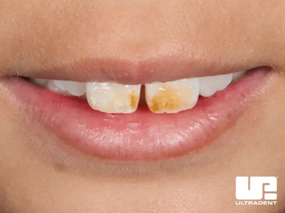 Before Opalustre Abrasion Slurry