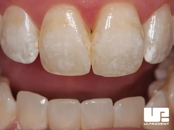 Before Opalustre Abrasion Slurry