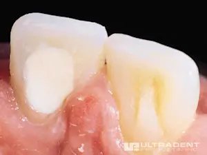 Step 2