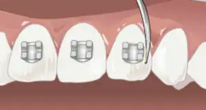 Step 4