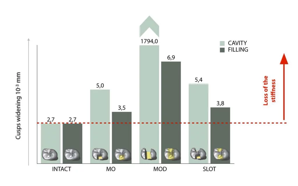 Cuspal widening as an indicator of loss of stiffness