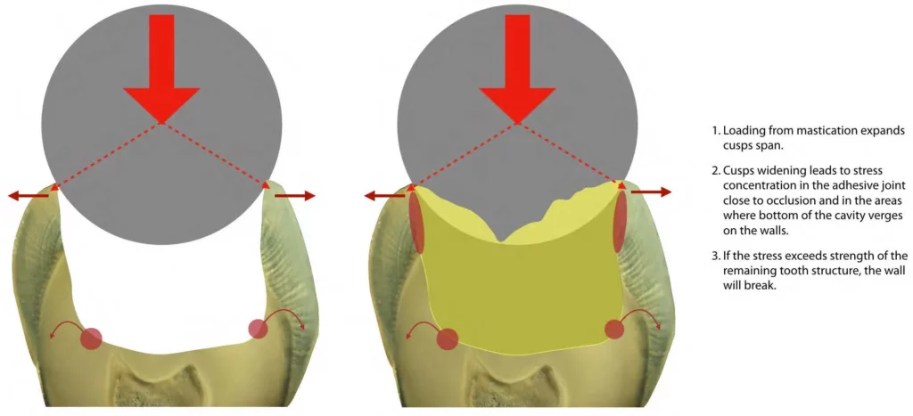 Schematic representation of stress concentration derived from mathematical models