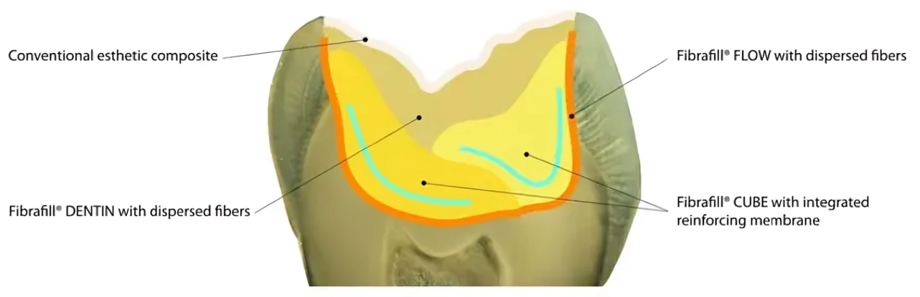 Use DENTIN independently or as part of the Fibrafill system